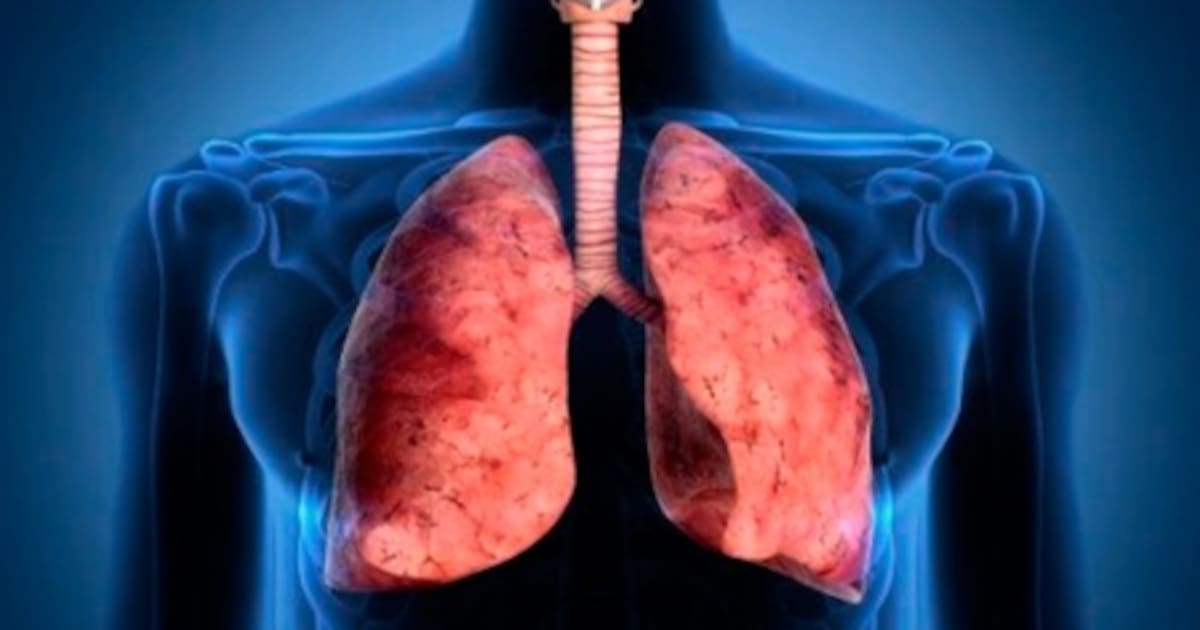 El estudio médico que puede prevenir la muerte por cáncer de pulmón - El Cronista thumbnail