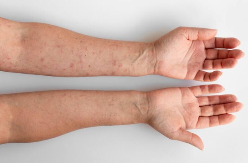 Adiós manchas de la piel: los productos naturales que te ayudarán a lucir una piel más joven. Fuente: archivo.