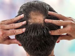 La solución fácil y rápida para la calvicie: este es el remedio casero que ayuda a prevenir la caída del cabello