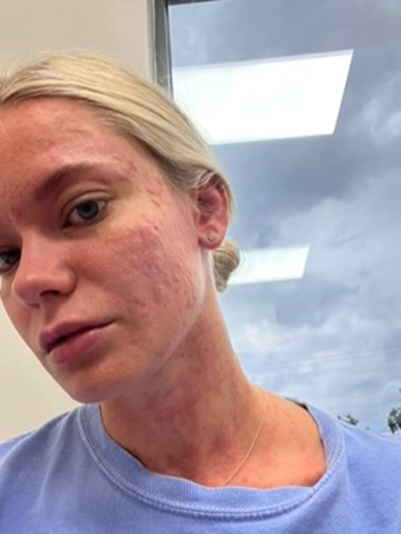 La piel de la joven apareció brotada, roja e irritada al día siguiente de usar la prenda. (Fuente: TikTok vía Becca)