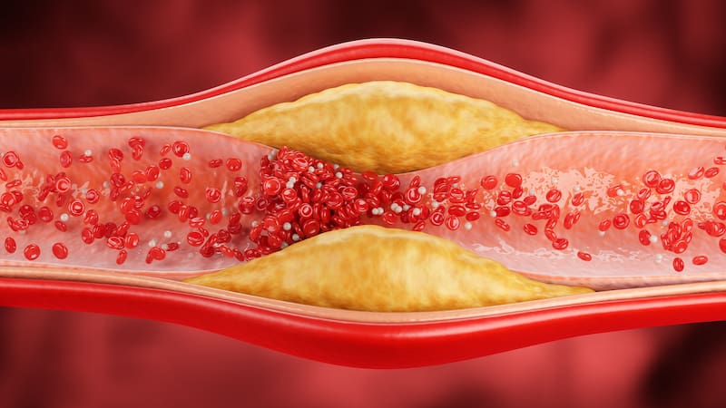 El colesterol alto es uno de los problemas de salud más frecuentes en la población adulta. Foto (Archivo)