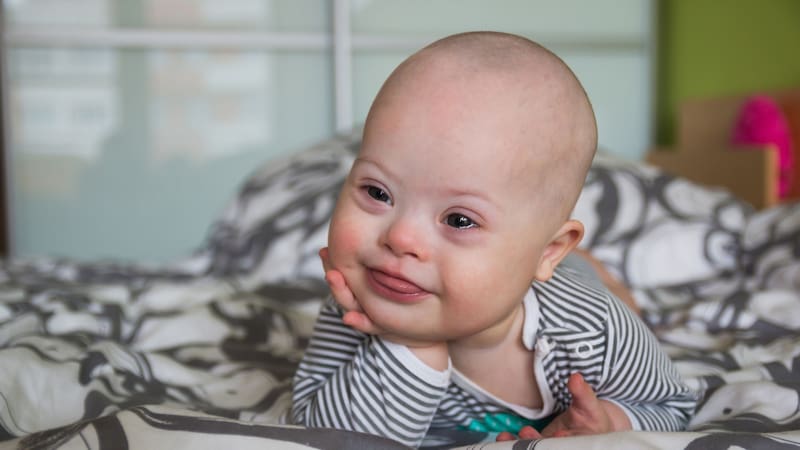 España es el país con la mayor tasa de interrupciones de embarazos por Síndrome de Down, ¿cuáles son los motivos?