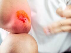 Atención | Esto es lo que nunca debes hacer para curar una herida