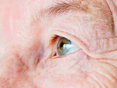 Cataratas: el primer síntoma que todos ignoran, pero podría dejarte ciego si no se trata a tiempo