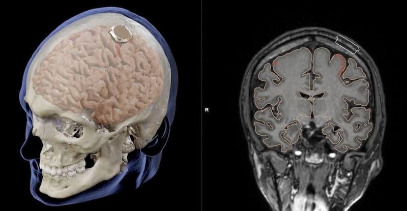 A diferencia del implante de Neuralink (arriba), que penetra el tejido cerebral con electrodos de alta resolución, el NEO utiliza un diseño epidural.