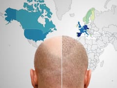 España tiene el mayor porcentaje de hombres calvos: casi la mitad pierde el cabello y este es el motivo