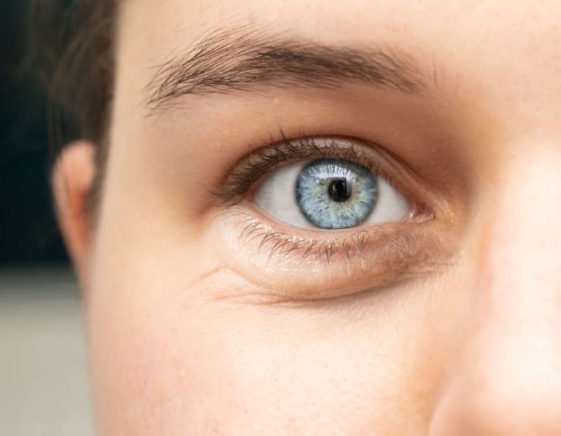 Adiós a las bolsas debajo de los ojos: trucos naturales para eliminarlas para siempre (foto: archivo).