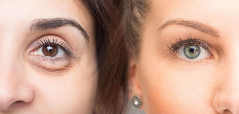 Adiós a las bolsas debajo de los ojos: trucos naturales para eliminarlas para siempre (foto: archivo).