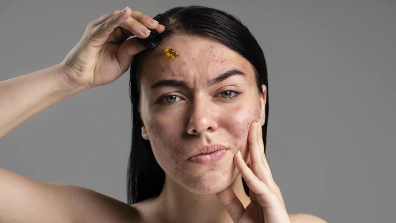 Diferentes tratamientos tradicionales tienen efectos secundarios para la piel, pero una hierba medicinal podría ofrecer una solución suave.