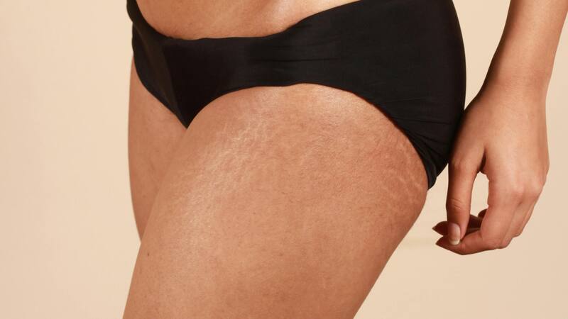 Las estrías no solo afectan a las mujeres; los hombres también pueden desarrollarlas. (Foto: Pixabay)