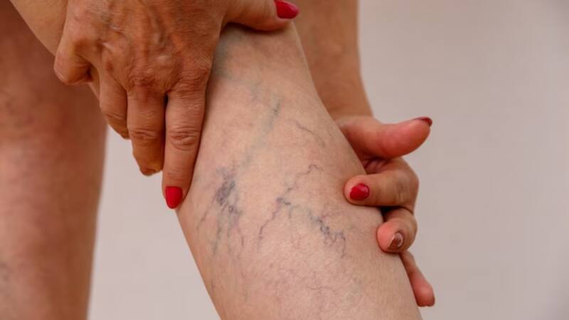 La edad es un factor de riesgo para desarrollar varices, especialmente después de los 70 años (Fuente: Freepik)