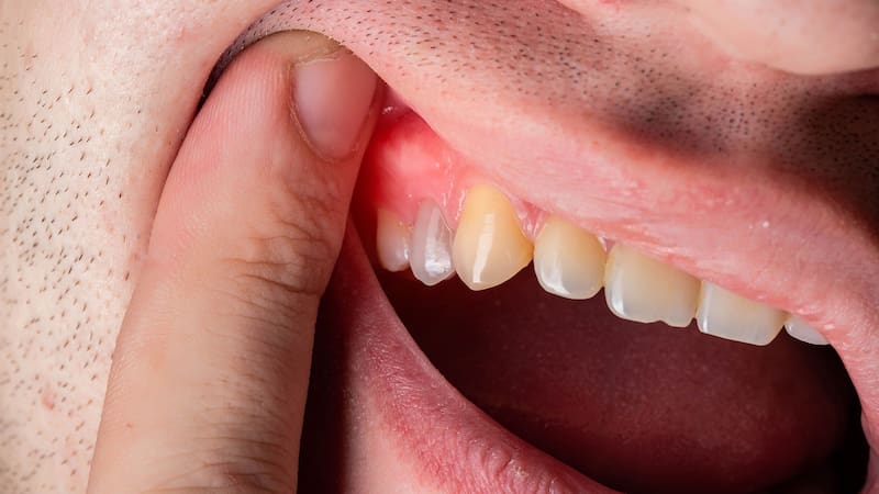 Muchas personas se enfocan en cepillarse los dientes para prevenir caries, pero olvidan que la salud de las encías es igual de importante. Imagen: archivo.