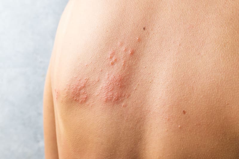 Los síntomas del herpes zóster suelen aparecer en una sola zona del cuerpo.