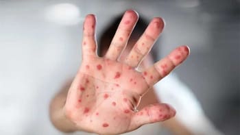 Los casos de varicela registrados en 2026 son 65% superiores a los del año pasado