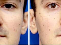 Efecto Selfie: la nariz se ve más grande y empuja a la gente a la cirugía estética