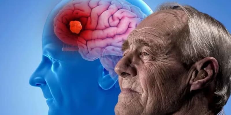 Descubren que un medicamento contra el cáncer podría ayudar a tratar el Alzheimer. Imagen: archivo.