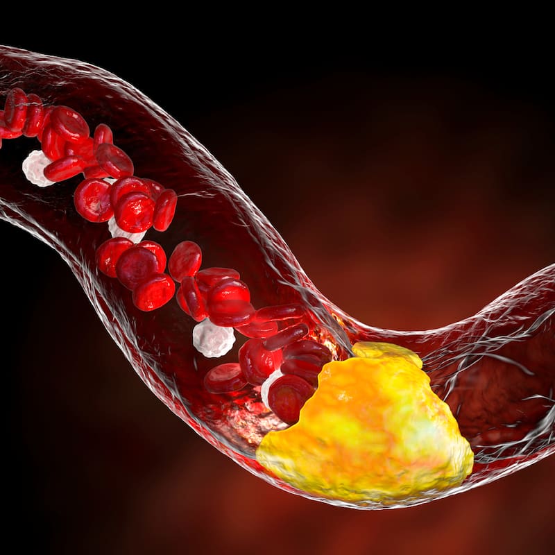 Los altos niveles de colesterol pueden generar que se estrechen las arterías.