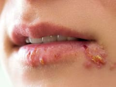 Adiós a la culebrilla: el remedio natural para curar las ampollas del herpes zóster y que no salgan más