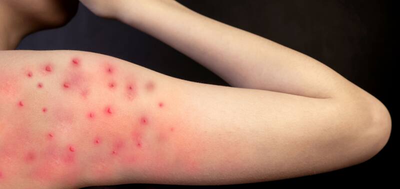 Según señaló la OMS, la región más afectada es el continente africano. Fuente: archivo.