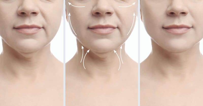 La papada suele formarse por la capa de grasa subplatismal, ubicada entre los músculos digástricos que conectan el mentón con el hueso hioides.