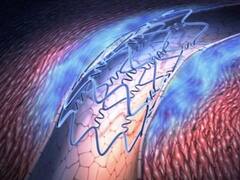 Se implantó con éxito el primer stent bioabsorbible de magnesio en el país