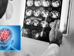 Tumor cerebral: tenía 44 años, presentó un inusual síntoma y recibió el peor diagnóstico