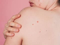 Cáncer de piel: la fuerte advertencia de un dermatólogo de Harvard que no puede pasar desapercibida
