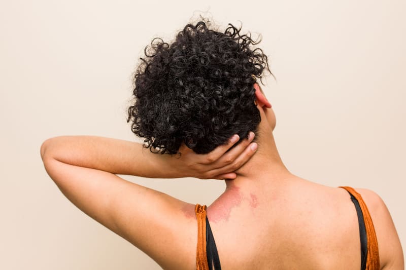 Las manchas de nacimiento: ventanas a vidas pasadas. Fuente: Shutterstock.