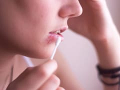 No es Aloe Vera: este es el remedio casero que ayuda a reducir el herpes y combate infecciones