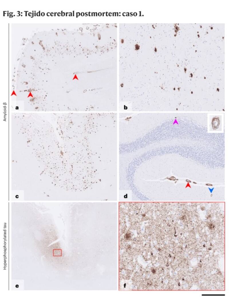 Tejido cerebral - postmortem. Fuente: Nature.es