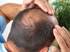 Adiós a la alopecia: reconocido científico de Harvard reveló cual es la solución para la caída del cabello