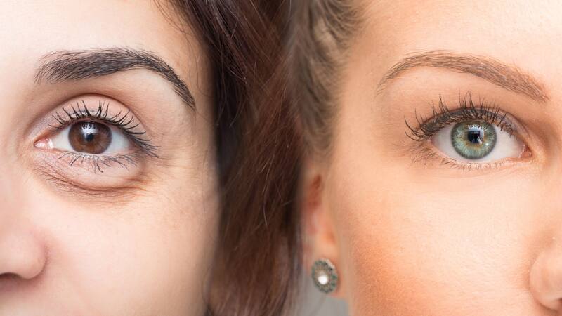 El truco para eliminar las bolsas debajo de los ojos para siempre con remedios naturales.