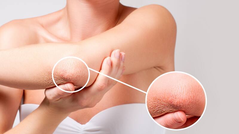 Adiós a codos secos y oscuros: los mejores tratamientos naturales para tener una piel tersa y luminosa.