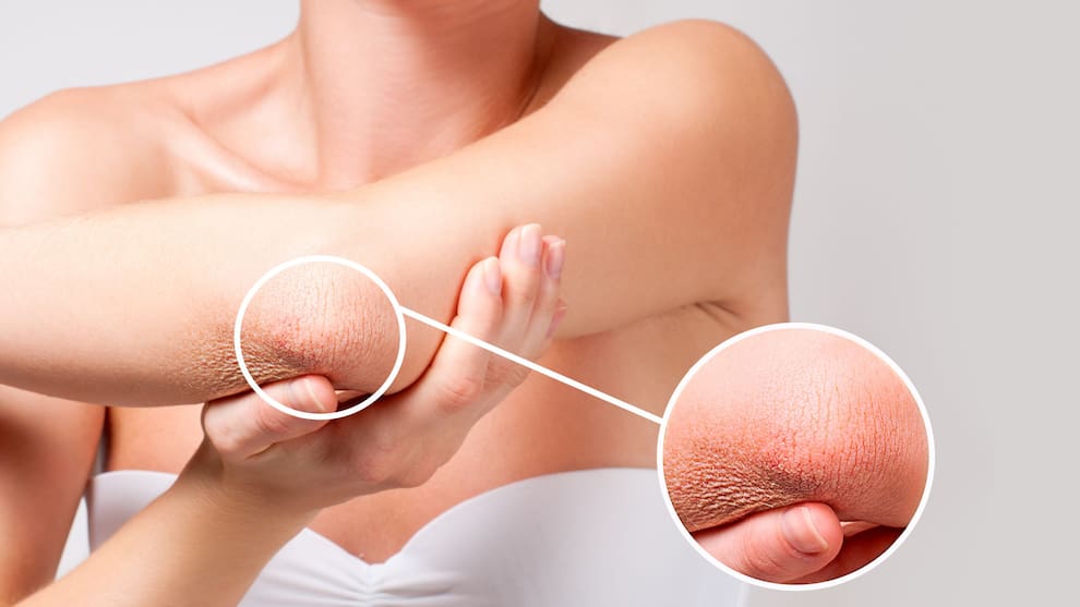 Codos Secos Cómo eliminar los codos secos: la crema casera ideal que hidrata la ...