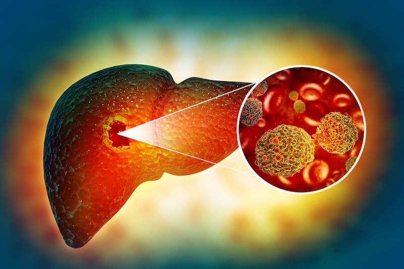 La pérdida de peso sin causa aparente puede ser uno de los primeros signos de cáncer de hígado, según la American Cancer Society. (Fuente: Archivo)