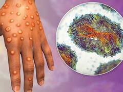 ¿Llegó la viruela del mono a Argentina? Qué se sabe del buque aislado en el Río Paraná