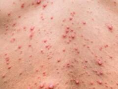 ALERTA Viruela del mono en Argentina: dos reconocidos infectólogos advierten qué puede pasar si suben los casos en el país