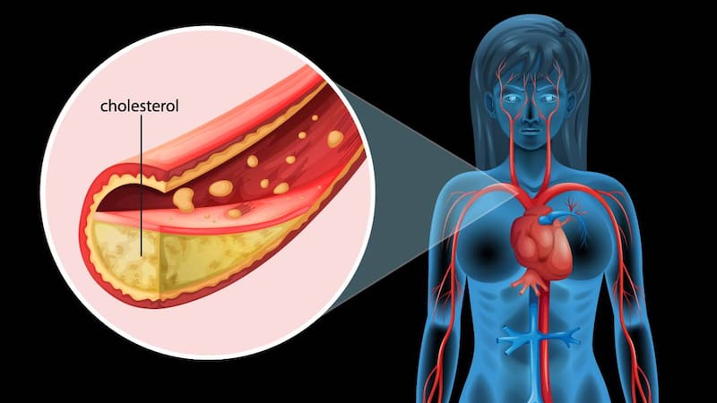 Una dieta equilibrada y saludable, junto con el ejercicio regular, son fundamentales para mantener niveles óptimos de colesterol y proteger la salud del corazón. (Foto: Archivo).