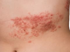 Vacuna contra la culebrilla: ¿cuándo llega a la Argentina, cómo prevenir la infección y cómo se puede curar?