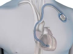 Sin cirugías: conocé el marcapasos que podría salvar tu vida