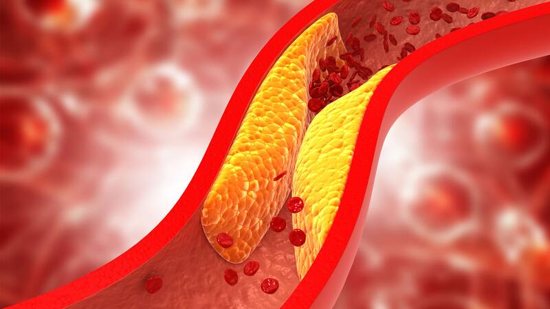 El colesterol alto puede provocar la acumulación de placa en las arterias, lo que dificulta el flujo sanguíneo y aumenta el riesgo de accidentes cardiovasculares. (Foto: Archivo).