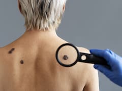 El método casero para quitar las verrugas para siempre: así podrás evitarlas y tener una piel más saludable