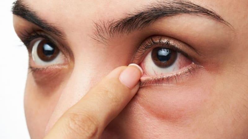 Los orzuelos pueden ser muy molestos para las personas.