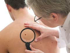 Juan Carlos Quero, oncólogo, explicó cuándo un lunar nos debe preocupar: "Ahí es cuando debes ir al médico"