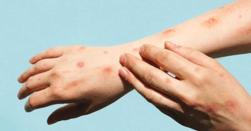 Alerta mundial por los casos de viruela del mono. (Foto: archivo).