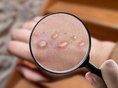 Alerta en México | Crecen los casos de la viruela del mono y ahora estos son los dos estados más afectados