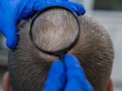 Fin de la discusión: España es el país con más calvicie del mundo y esta es la comunidad con más calvos