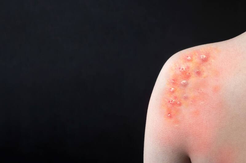 Los casos de mpox en España. (Foto: Shutterstock).