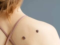 ¿Cómo saber si un lunar es peligroso? Las cinco señales que alertan sobre el cáncer de piel