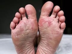 Pie de atleta: ¿cómo se origina y qué se puede hacer para prevenirlo?